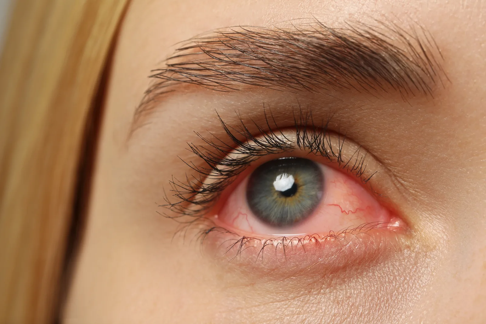 Close-up van een rood en geïrriteerd oog.