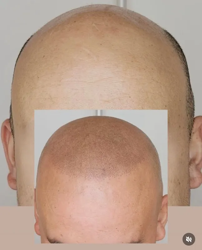 haarpigmentatiebelgie
