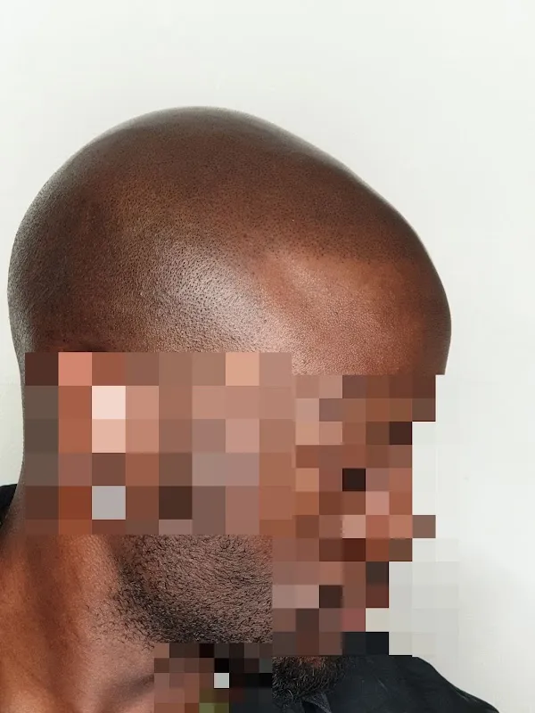 Scalp Esthetik