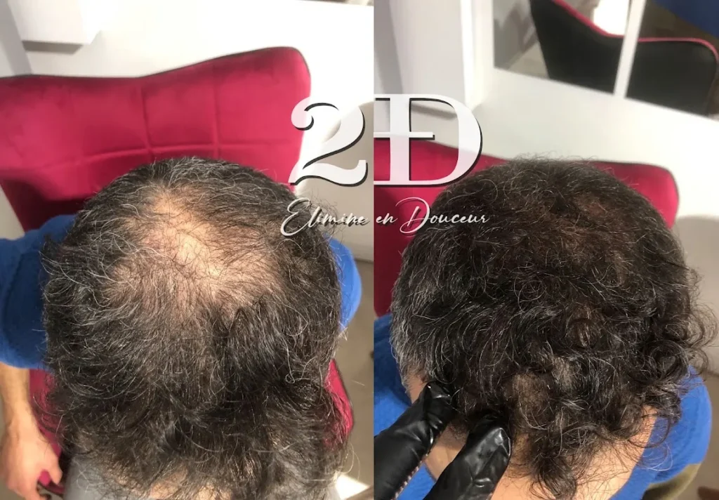 Solution Capillaire à Uccle – Tricopigmentation – Micro Pigmentation capillaire