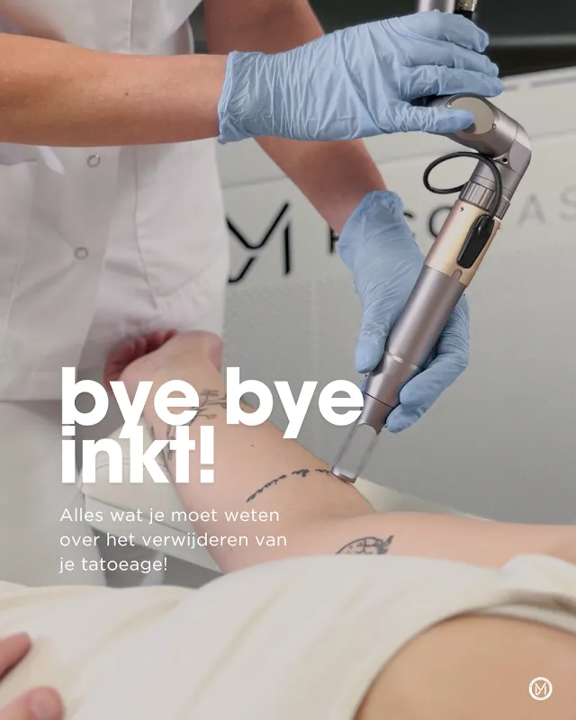 Tattoo laten Verwijderen